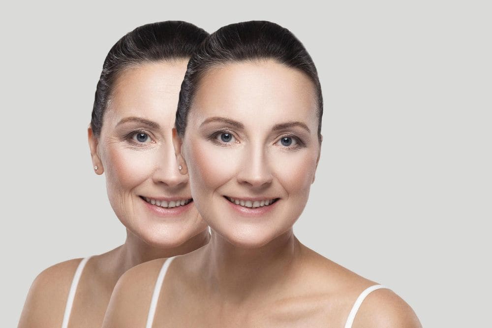 Armonización facial con grasa